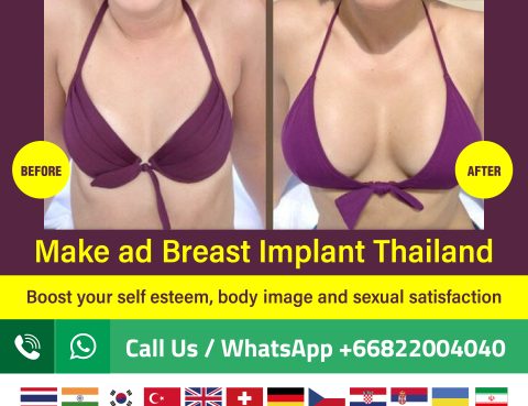 breast implant