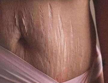 Stretch Marks