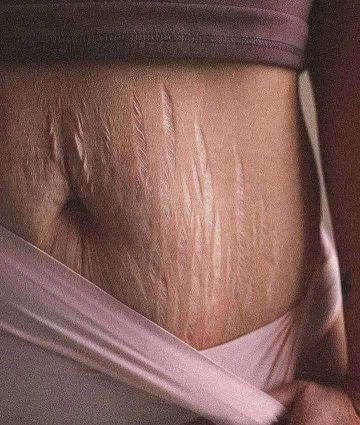 Stretch Marks