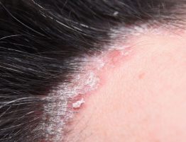 Psoriasis