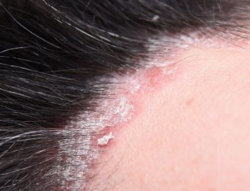 Psoriasis