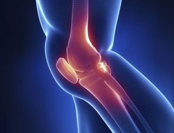 Knee Osteoarthritis