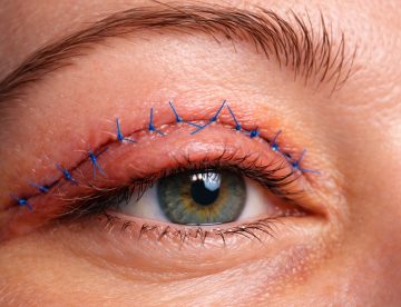 Eyelid Surgery