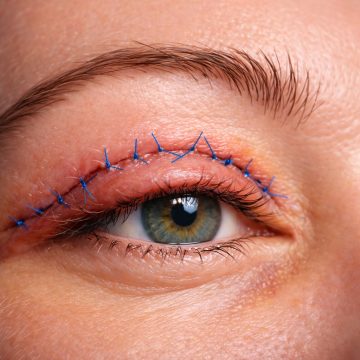 Eyelid Surgery
