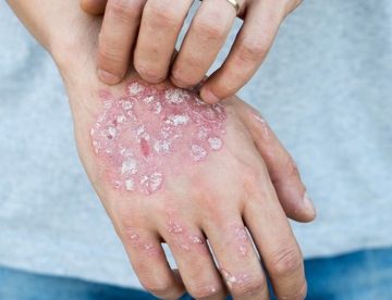Psoriasis
