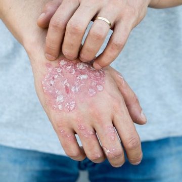 Psoriasis