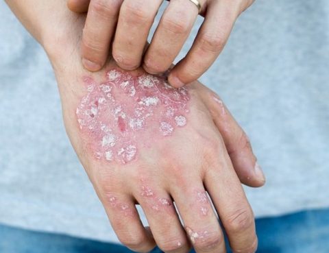 Psoriasis