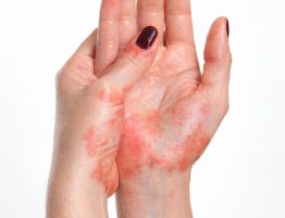 Eczema
