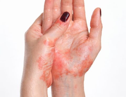 Eczema