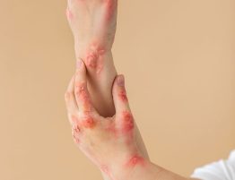 Psoriasis