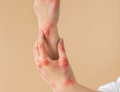 Psoriasis