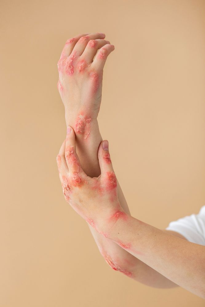 Psoriasis